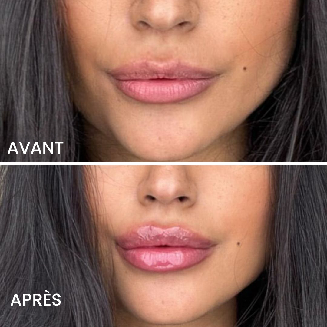 Volumateur Lipso